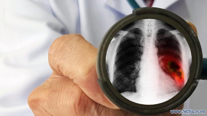 Doctors physical examination for screening lung cancer